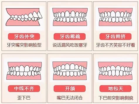 上下排牙齒平行|牙齒矯正咬合問題：如何調整上排牙齒位置？